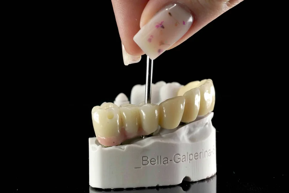 Screw-retained restoration on a model, showing the screw access channel