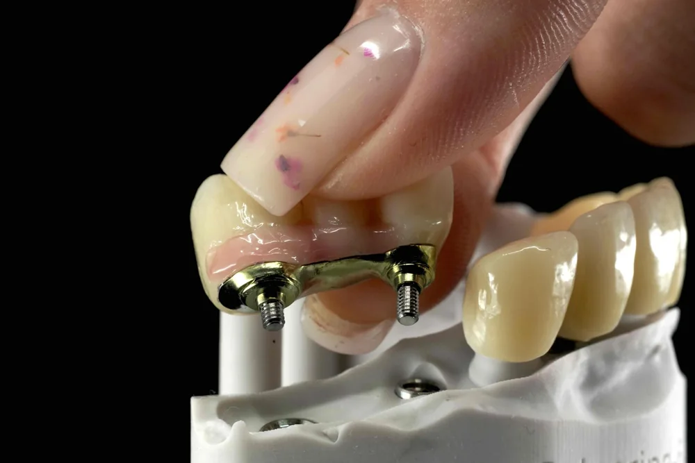 Underside of a screw-retained restoration, showing implant connections